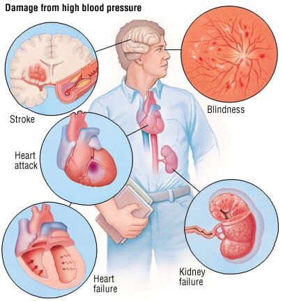 hyper blood pressure symptoms