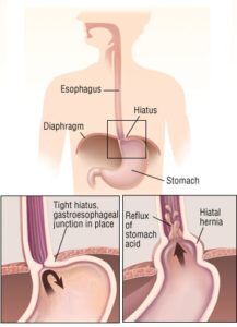 Patient Basics: Hiatal Hernia | 2 Minute Medicine