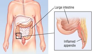 appendicitis semaglutide Patient Basics: Appendicitis