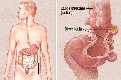 can semaglutide cause diverticulitis Patient Basics: Diverticulosis and Diverticulitis