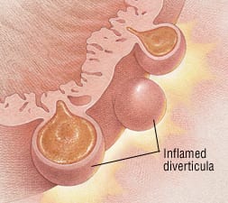 can you take semaglutide with diverticulitis Patient Basics: Diverticulosis and Diverticulitis