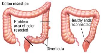 semaglutide and diverticulitis Patient Basics: Diverticulosis and Diverticulitis
