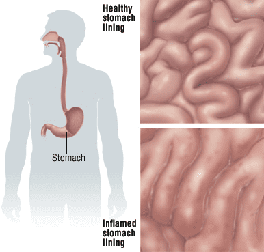can smoking cigarettes cause gastritis Overview of  It's Symptoms, Types, Causes, Diagnosis & Treatment: Bharat Dasani, MD: Gastroenterologist What Is Gastritis? Symptoms, Causes,
