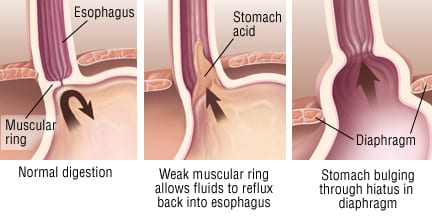 does semaglutide cause gerd Can Ozempic Heartburn? Ozempic and Heartburn: What's the