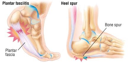 semaglutide foot pain Ozempic feet | neuropathy Patient Basics: Heel Pain |