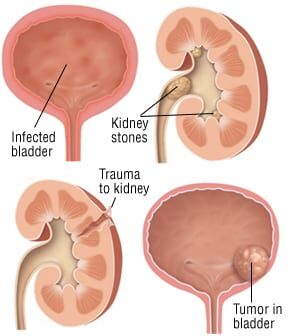 Patient Basics: Hematuria