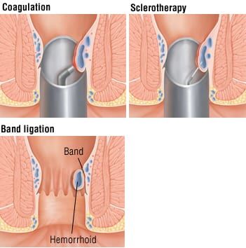 does tirzepatide cause hemorrhoids Patient Basics: Hemorrhoids