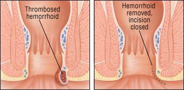 bpc 157 hemorrhoids Patient Basics: Hemorrhoids