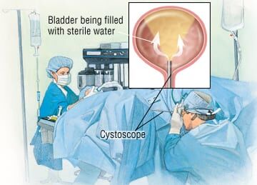 Patient Basics: Interstitial Cystitis