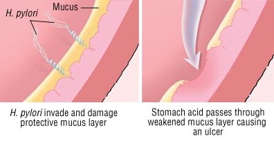 Patient Basics: Peptic Ulcer