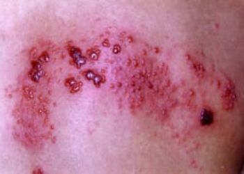 semaglutide and shingles Turns out it was : r/Ozempic Shingles