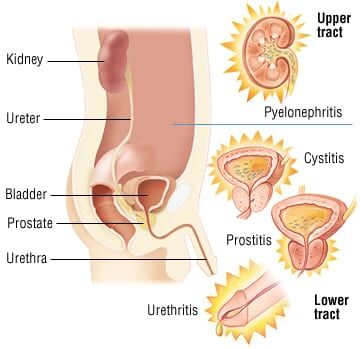 semaglutide bladder infection Urinary Tract Prevention Labmed Egypt | Urine Culture