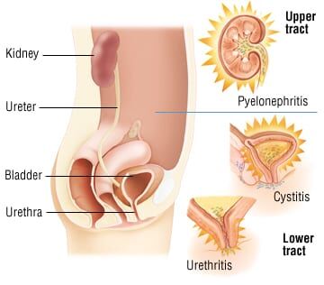 will semaglutide cause uti and UTI: does GLP-1 therapy increase urinary tract infection risk? Can Wegovy Cause Yeast Infection