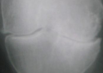 tirzepatide arthritis Semaglutide and tirzepatide may be cost-effective for knee osteoarthritis  in patients with obesity