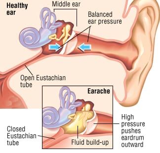 Patient Basics: Earache | 2 Minute Medicine