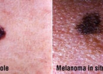 Amelanotic melanoma linked with advanced stage at diagnosis | 2 Minute Medicine Amelanotic melanoma linked with advanced stage at diagnosis | 2 Minute Medicine